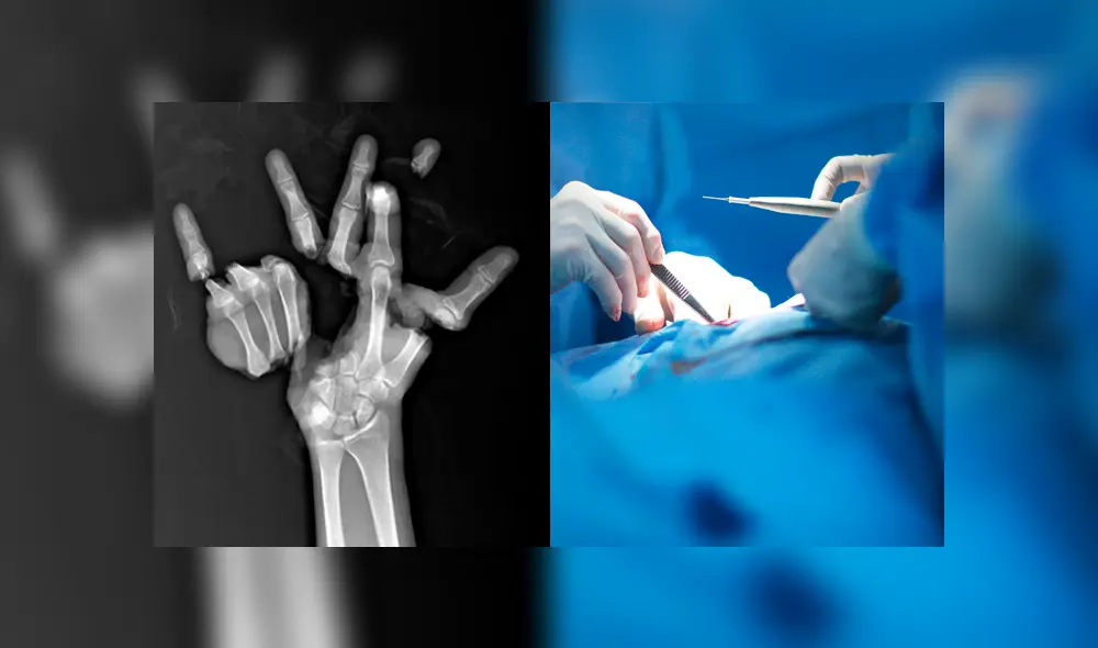 El doctor Wichit Siritattamrong reconstruyó la mano de un trabajador tailandés. Foto: Composición