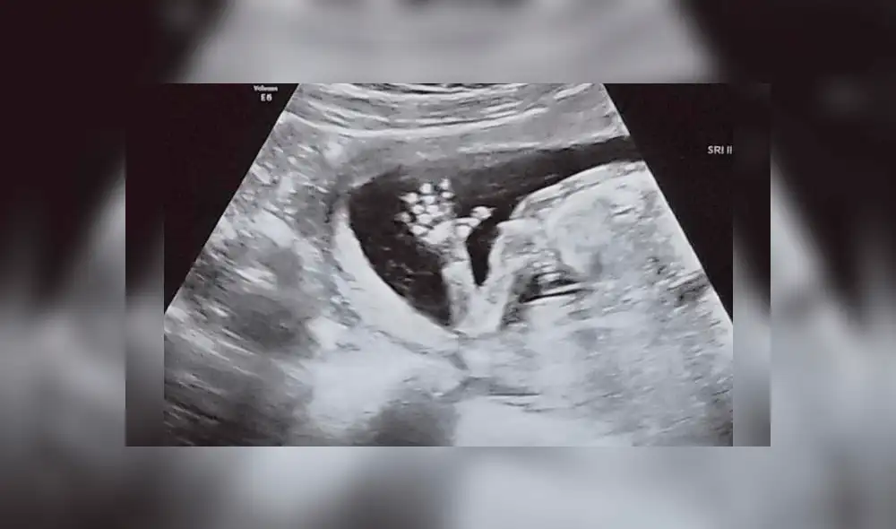 Mujer embarazada se hace ecografía y descubre que tiene dos vaginas y dos úteros