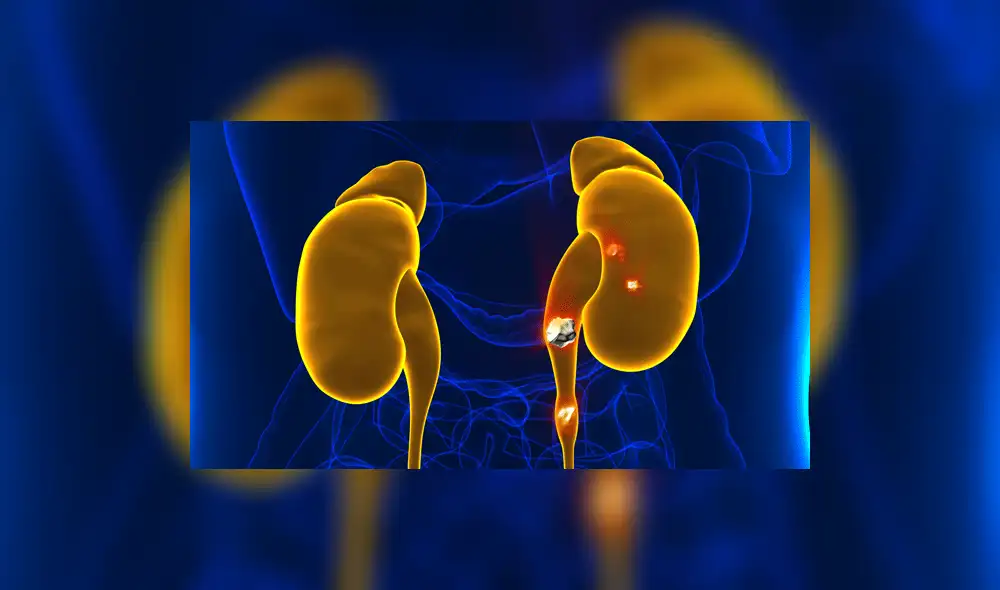 Cálculos Renales. ¿Cuáles son los síntomas y tratamientos?