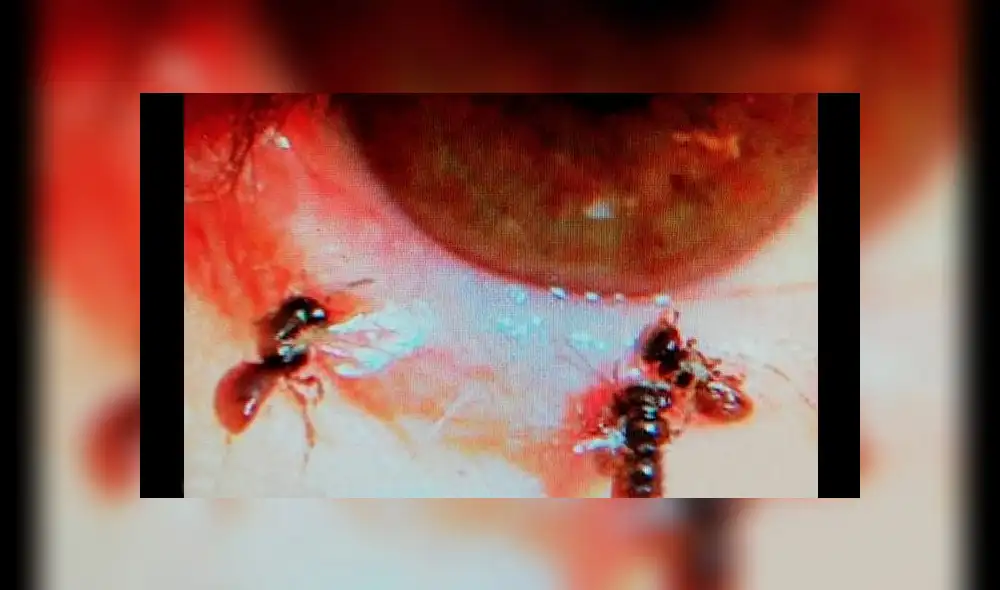 Médicos encuentran cuatro abejas vivas dentro del ojo de una mujer [FOTOS]