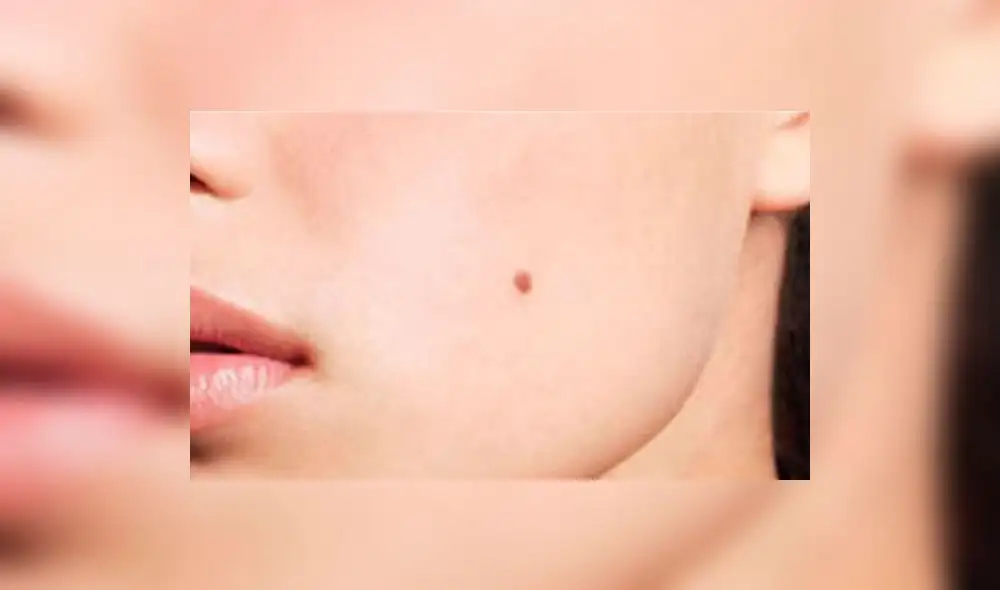 Más de la mitad de casos de cáncer de piel son por radiación ultravioleta