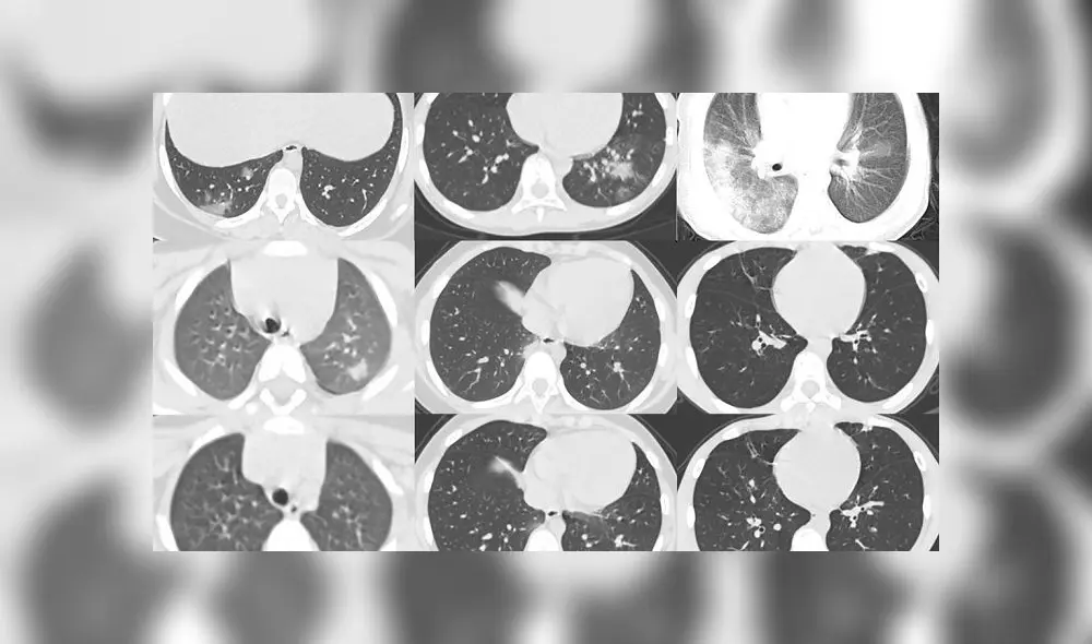 Algunas tomografías computarizadas de niños con coronavirus. Foto: Pediatric Pulmonology Algunas tomografías computarizadas de niños con coronavirus. Foto: Pediatric Pulmonology