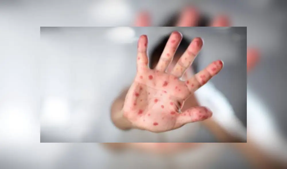 ¿Cómo distinguir entre el sarampión y la varicela?: Conoce las cinco diferencias