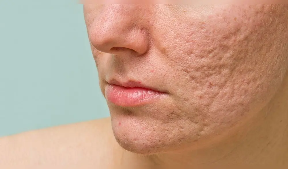 Científicos preparan vacuna para combatir el acné