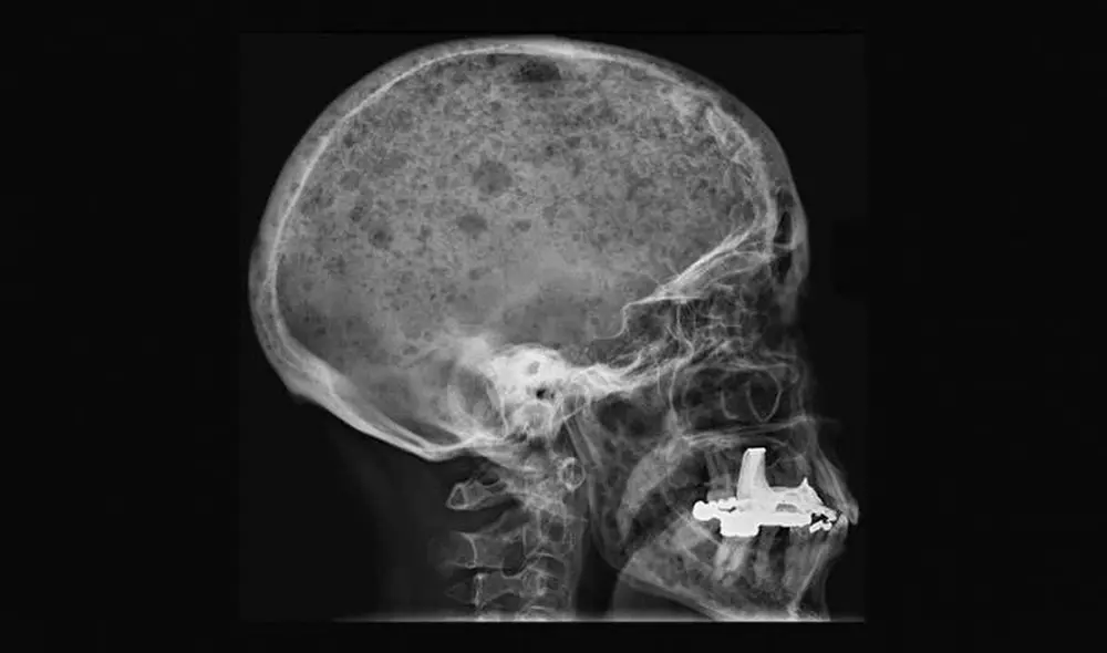 Las personas que padecen cáncer de médula ósea suelen presentar perforaciones en el cráneo que les generan mucho dolor | Foto: Dra. Jennie Roberts, Radiopaedia.org Las personas que padecen cáncer de médula ósea suelen presentar perforaciones en el cráneo que les generan mucho dolor | Foto: Dra. Jennie Roberts, Radiopaedia.org