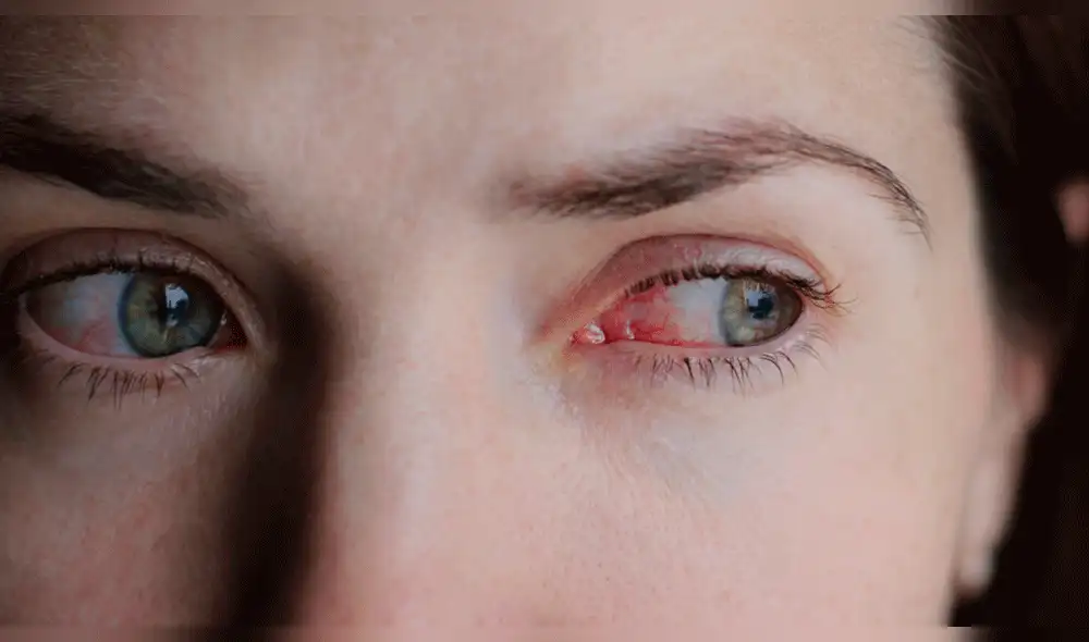¿Qué es la conjuntivitis? Síntomas y tratamientos en niños y adultos