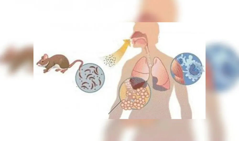 El síndrome pulmonar del hantavirus se parece a una influenza. Foto: Infogate. El síndrome pulmonar del hantavirus se parece a una influenza. Foto: Infogate.
