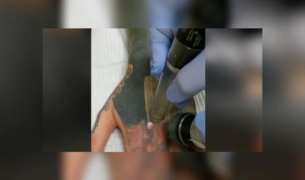 Facebook viral: joven decide quitarse tatuaje del brazo, sin imaginar el terrible resultado que tendría