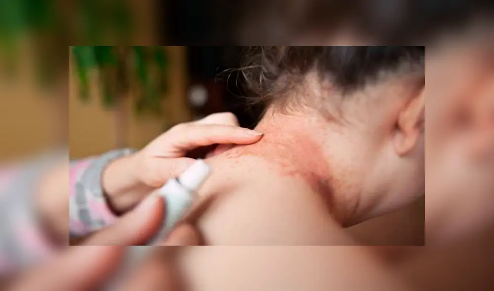 Manchas negras:¿Qué son y cómo curar sus apariciones en el cuello y axilas?