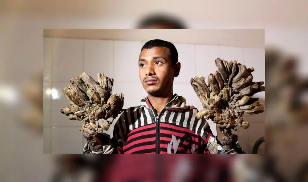 Abul Bajandar fue conocido en 2016 como el 'hombre árbol' y hoy hace triste pedido. Foto: AFP Abul Bajandar fue conocido en 2016 como el 'hombre árbol' y hoy hace triste pedido. Foto: AFP