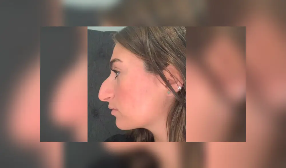 La joven mostró el antes y el después de su operación en la nariz y ahora luce totalmente diferente. Foto: captura La joven mostró el antes y el después de su operación en la nariz y ahora luce totalmente diferente. Foto: captura