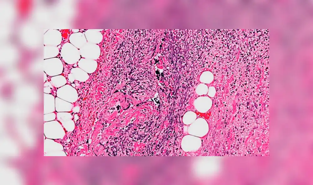 La fascitis necrotizante puede ser causada por diferentes tipos de bacterias, como Strep o Vibrio vulnificus del Grupo A. Foto: Difusión La fascitis necrotizante puede ser causada por diferentes tipos de bacterias, como Strep o Vibrio vulnificus del Grupo A. Foto: Difusión