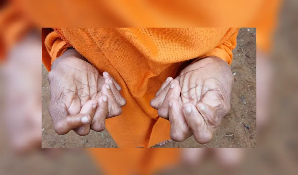 Mujer con 31 dedos en manos y pies rompe récord, pero sus vecinos la llaman ‘bruja’ [VIDEO]