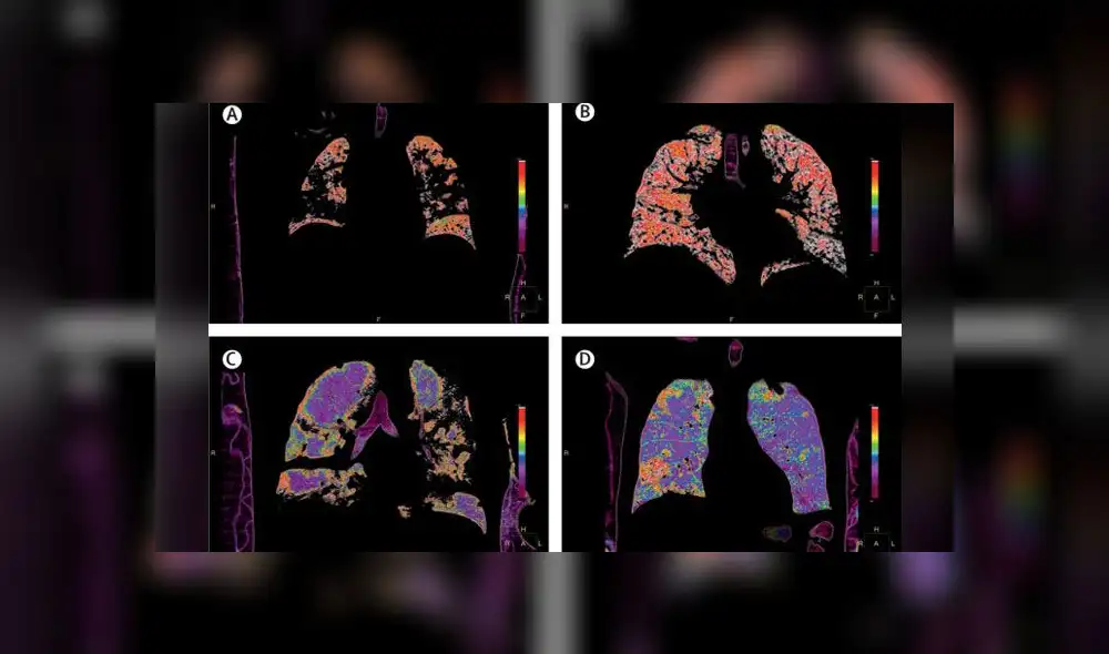 La investigación se centró en el "doble daño" e los pulmones. Imágenes: The Lancet / Grasseelli, et al. La investigación se centró en el "doble daño" e los pulmones. Imágenes: The Lancet / Grasseelli, et al.