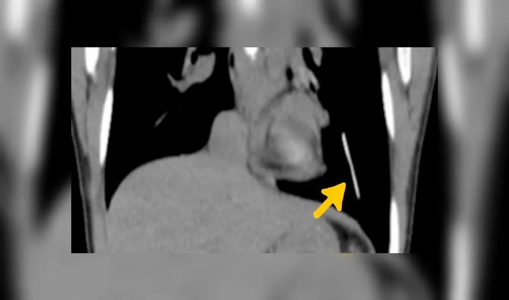 El implante anticonceptivo se había alojado en el pulmón izquierdo. Foto del estudio publicado en BMJ Case Reports (2019)