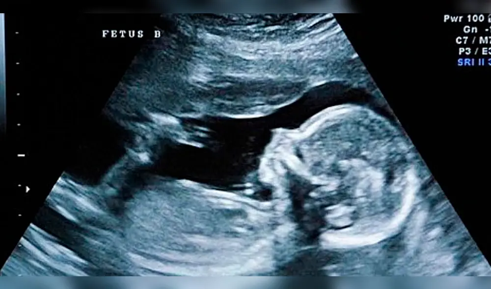 Youtube: bebé de 28 semanas “saluda” a sus padres en una ecografía