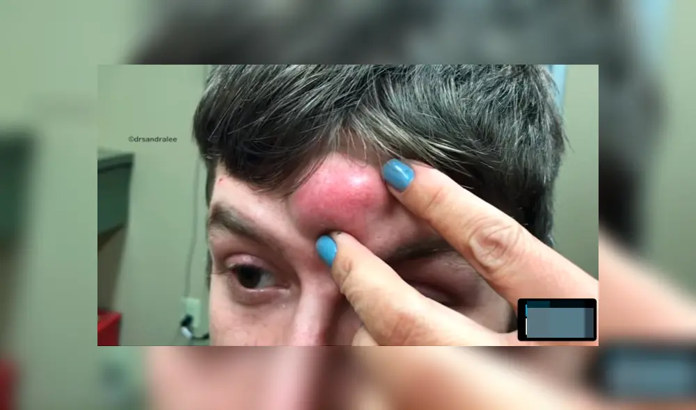 En YouTube, repugnante video de doctora que retiró espinilla gigante