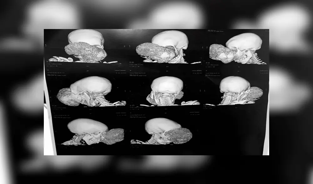 El cirujano español tuvo que intervenir a un niño africano y quitarle un tumor que era más grande que su cabeza. El cirujano español tuvo que intervenir a un niño africano y quitarle un tumor que era más grande que su cabeza.