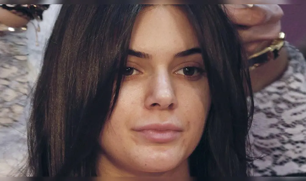 Kendall Jenner sufre por no poder ocultar las cicatrices del acné en su cara