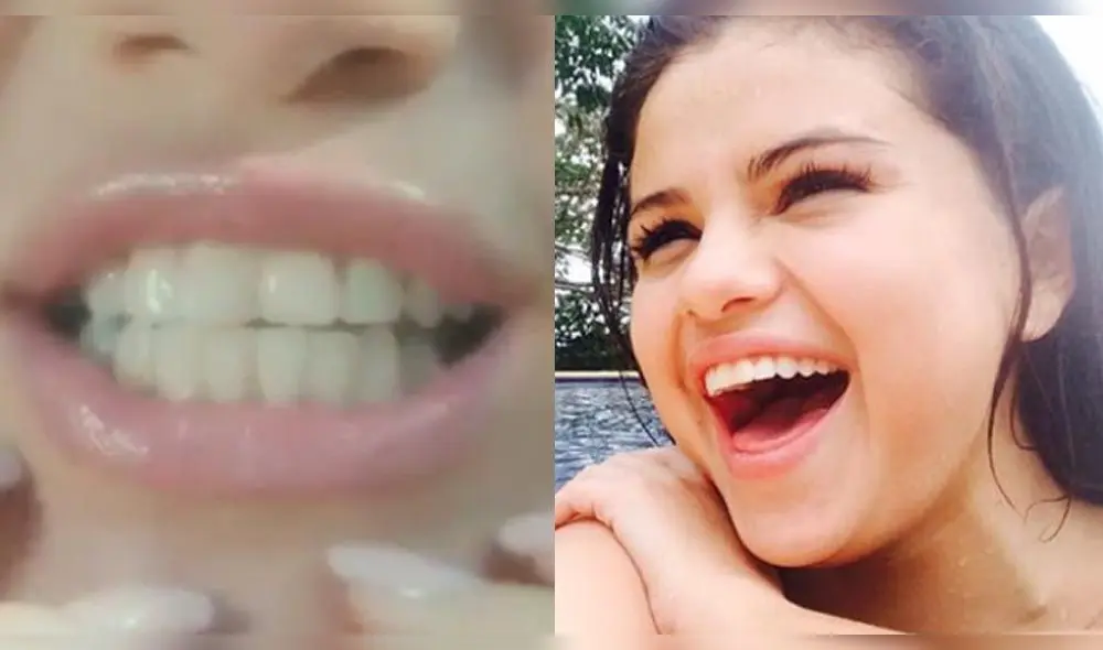 Selena Gomez tiene una nueva sonrisa gracias a las carillas estéticas en la boca. Fuente: Instagram Selena Gomez tiene una nueva sonrisa gracias a las carillas estéticas en la boca. Fuente: Instagram