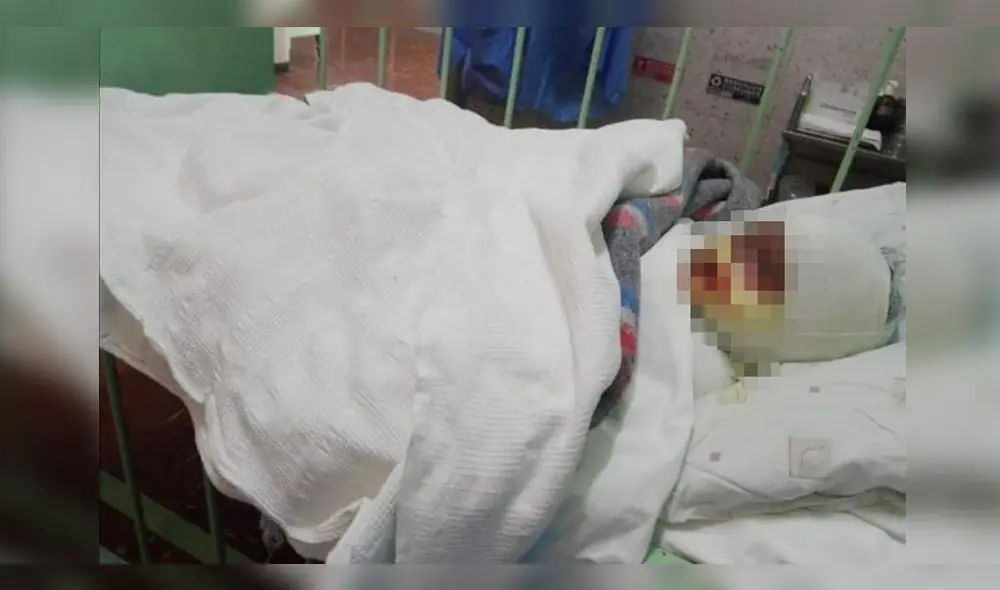 El niño será operado la próxima semana para injerto de piel. El niño será operado la próxima semana para injerto de piel.