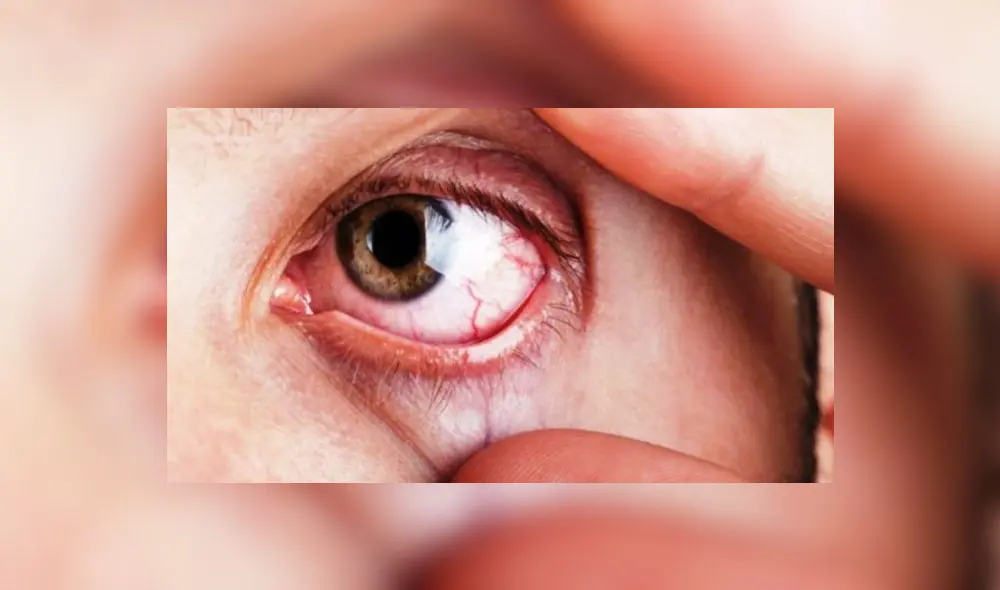 Conozca los nuevos alcances en el tratamiento del glaucoma Conozca los nuevos alcances en el tratamiento del glaucoma