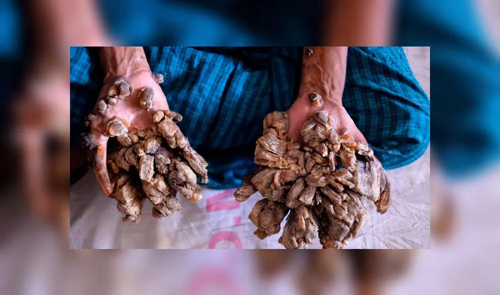 Abul Bajandar fue conocido en 2016 como el 'hombre árbol' y hoy hace triste pedido. Foto: AFP Abul Bajandar fue conocido en 2016 como el 'hombre árbol' y hoy hace triste pedido. Foto: AFP