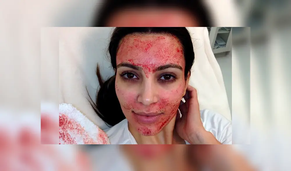 Mujeres contraen VIH al realizarse tratamiento facial de plasma