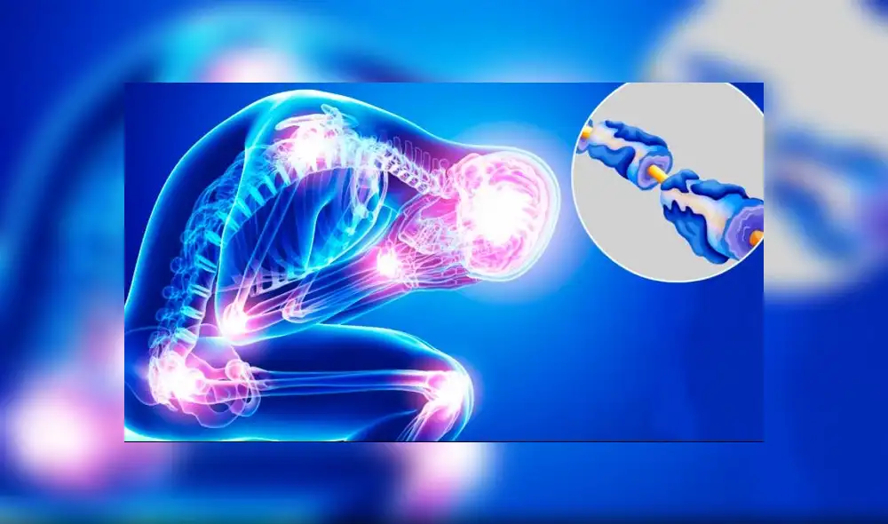 Síndrome de Guillain Barré: ¿Cómo prevenir avance de esta enfermedad?