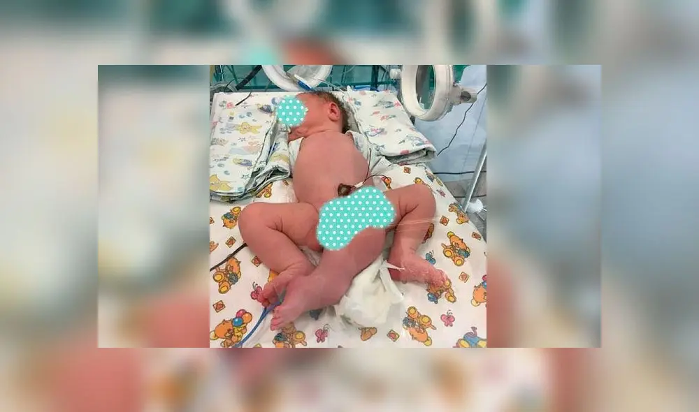 Médicos salvan la vida de un bebé que nació con tres piernas, dos genitales y sin ano [FOTOS]