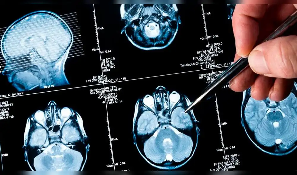 Niña salva de morir luego de que tumor cerebral que tenía desapareció inexplicablemente
