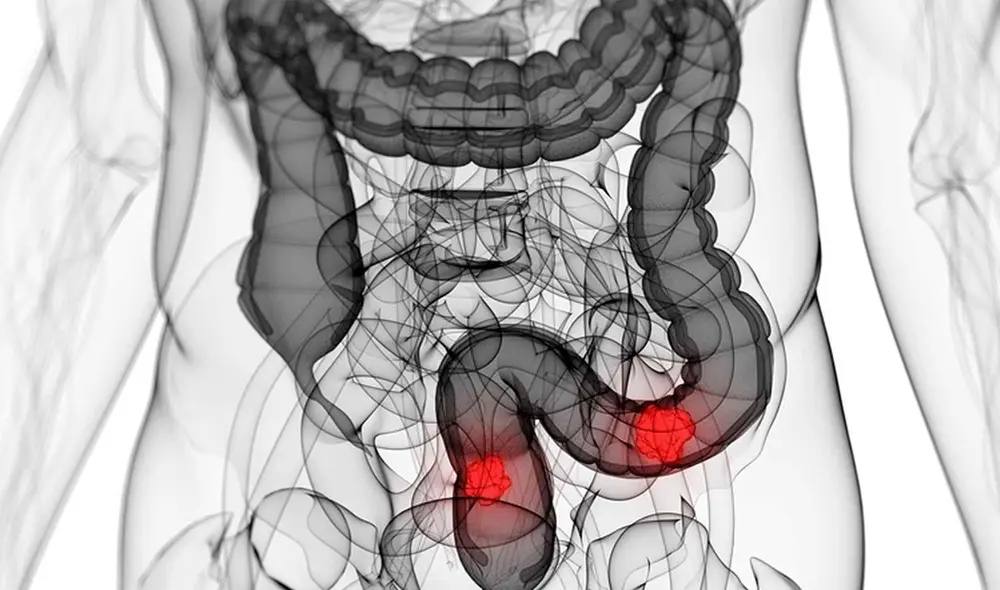 Los factores de riesgo del cáncer de intestino son la obesidad, el tabaquismo y el sedentarismo | Foto: Difusión