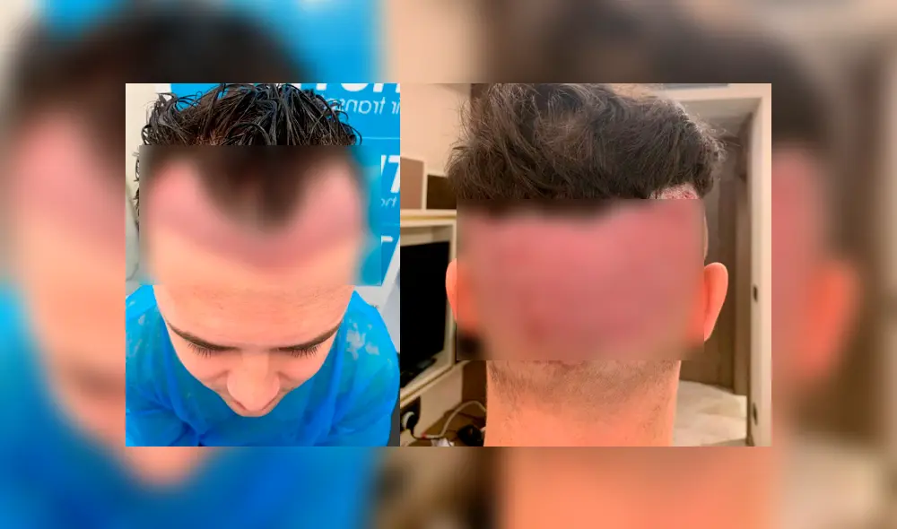 Tras el procedimiento, el joven no vio resultados positivos, en cambio terminó con horribles cicatrices. Foto: The Sun Tras el procedimiento, el joven no vio resultados positivos, en cambio terminó con horribles cicatrices. Foto: The Sun