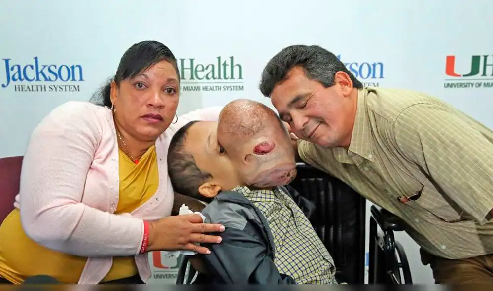 Emanuel, niño cubano con tumor en el rostro, falleció tras operación 