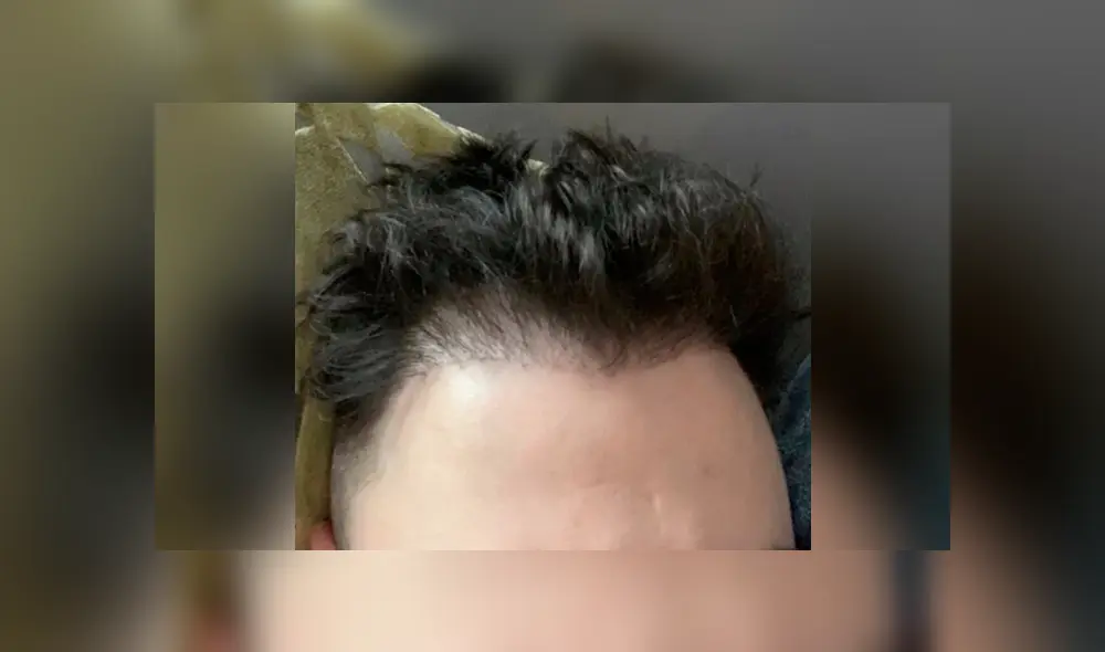 Luke sufría de calvicie en 2018 y se sometió a un trasplante capilar, pero quedó peor. Foto: The Sun Luke sufría de calvicie en 2018 y se sometió a un trasplante capilar, pero quedó peor. Foto: The Sun