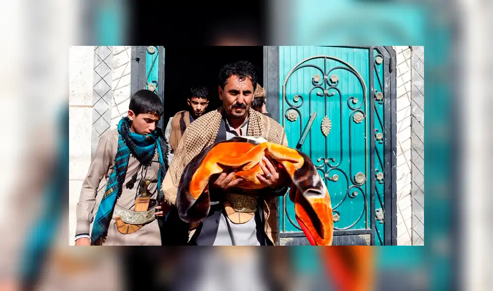 Bebés siameses mueren en Yemen al no recibir tratamiento [VIDEO]