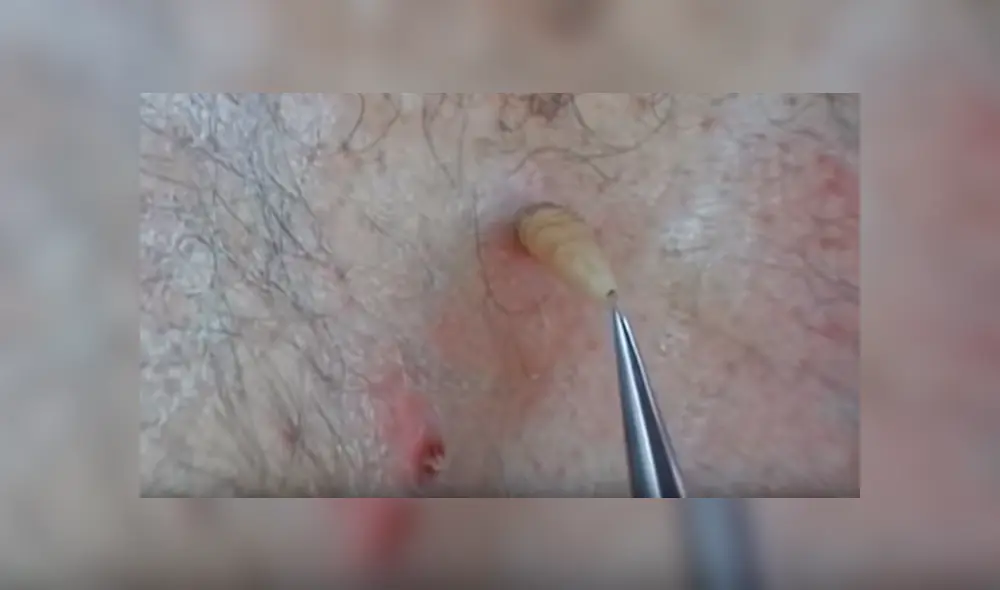 YouTube viral: joven va al médico por roncha en su espalda y le hacen espeluznante hallazgo [VIDEO]