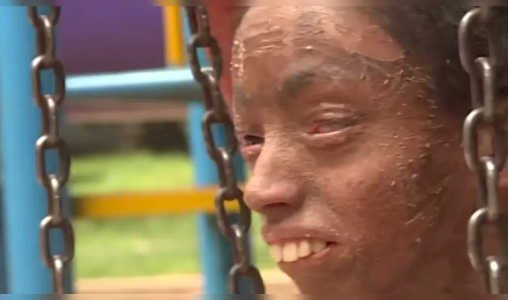 Nisha sufre de una de las afecciones cutáneas más raras del mundo. Foto: Captura.