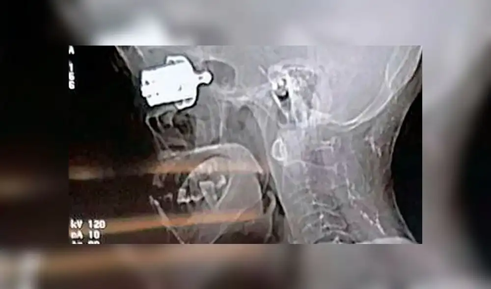 El silbato de la olla a presión alojado en el ojo de Munda Birsi. Foto: SWNS: South West News Service. El silbato de la olla a presión alojado en el ojo de Munda Birsi. Foto: SWNS: South West News Service.