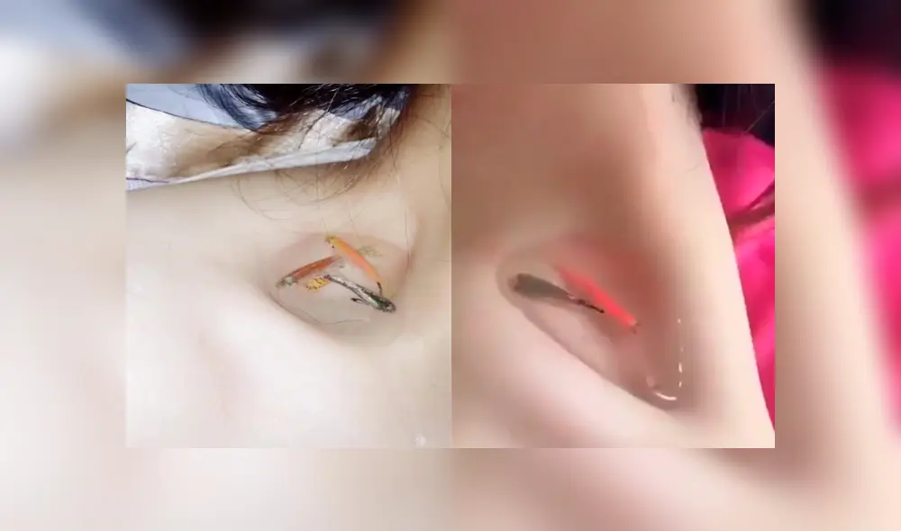 Facebook: el peligroso reto de colocarse peces en la clavícula para probar delgadez [VIDEO]