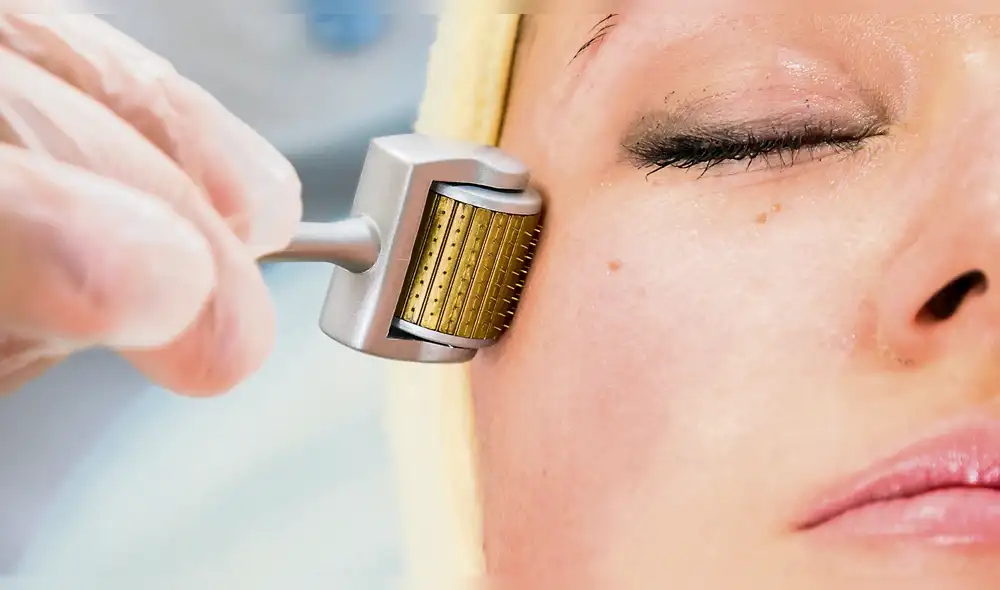 Terapia de inducción de colágeno