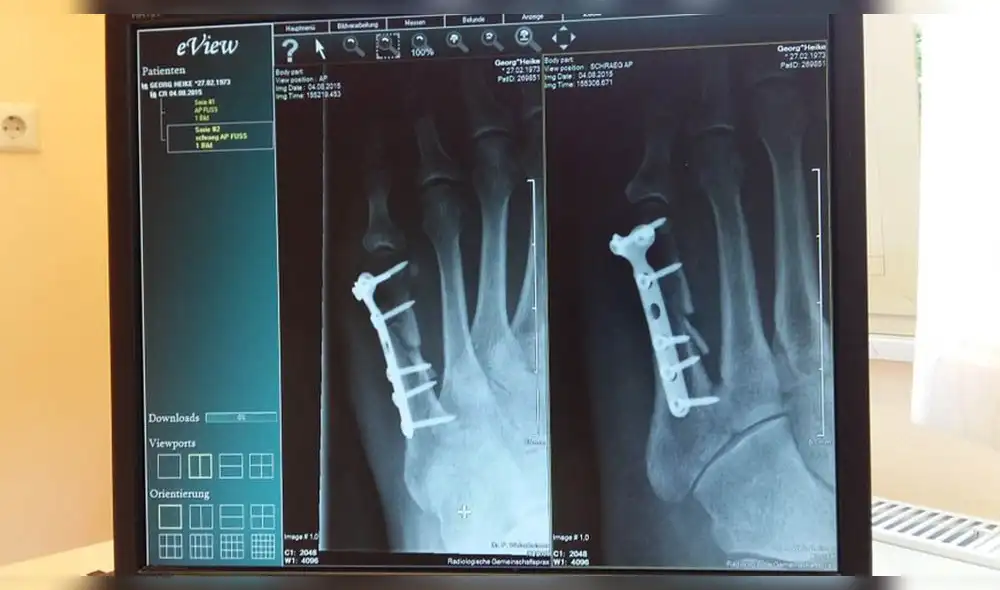 Rusia: desarrollan un método para acelerar la soldadura de huesos Rusia: desarrollan un método para acelerar la soldadura de huesos