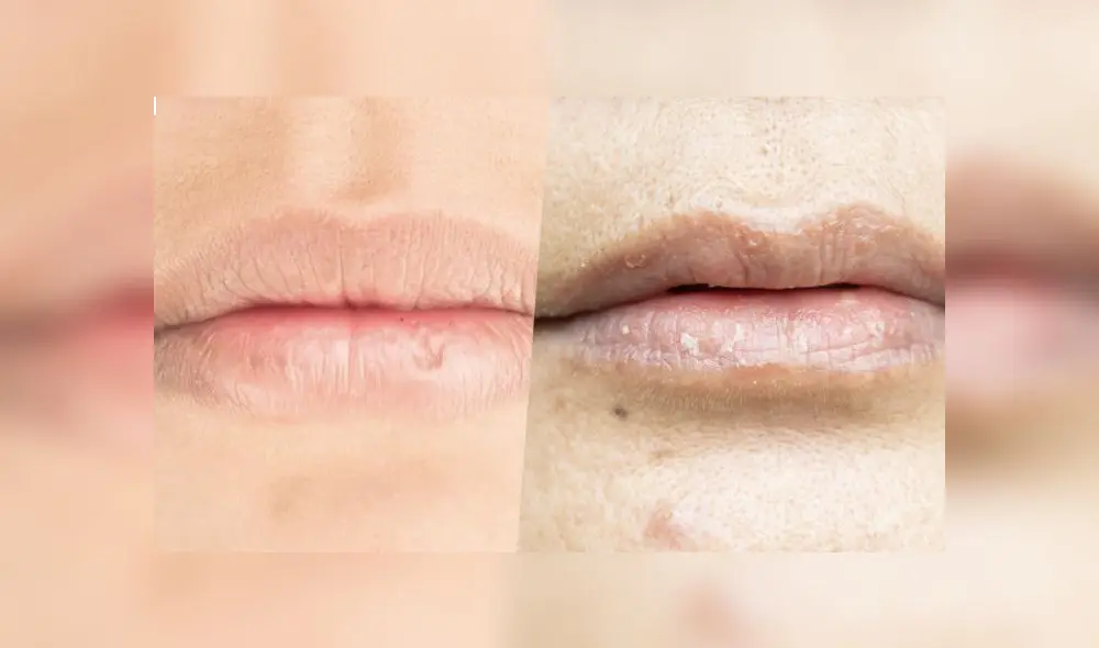 Conoce los factores que podrían llevar a que los labios se puedan irritar y hasta quebrar. Foto: Composición La República