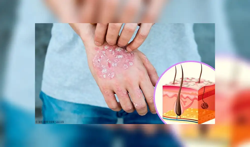 Pacientes con psoriasis deben mantener una alimentación saludable en su dieta