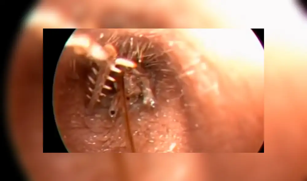 YouTube viral: médico encuentra 'misteriosa criatura' dentro de oído que genera terror [VIDEO]