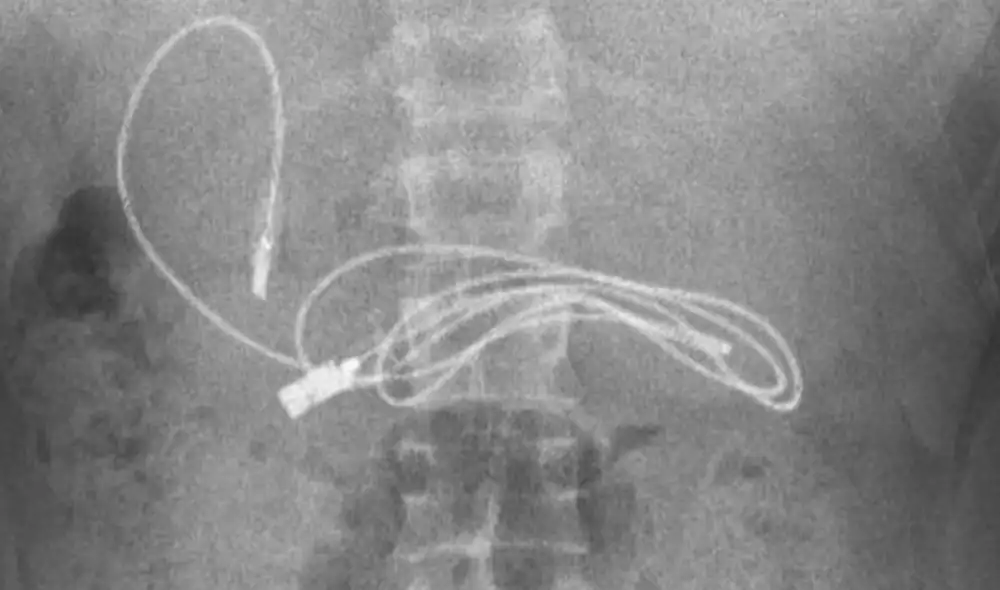 Radiografía que mostró el cable USB dentro del estómago del adolescente. Foto: Instagram/@prof.dr.yasardogan Radiografía que mostró el cable USB dentro del estómago del adolescente. Foto: Instagram/@prof.dr.yasardogan