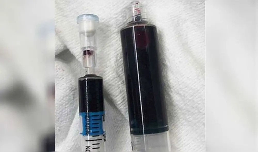 Los doctores de Rhode Island atendieron a una mujer que presentó un cuadro de fatiga crónica y tenía la sangre azul, luego de automedicarse por un dolor de muela. Foto: New England Journal of Medicine Los doctores de Rhode Island atendieron a una mujer que presentó un cuadro de fatiga crónica y tenía la sangre azul, luego de automedicarse por un dolor de muela. Foto: New England Journal of Medicine