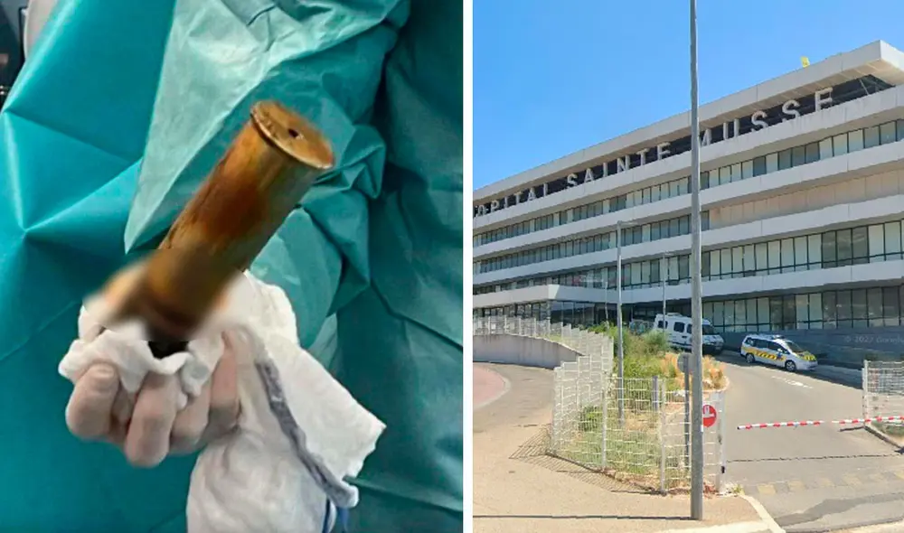 Al parecer, el hombre quería sentir placer sexual y por eso se insertó el objeto de casi 21 cm de largo y 5 cm de ancho. Foto: Composición LR / Medios de comunicación locales Al parecer, el hombre quería sentir placer sexual y por eso se insertó el objeto de casi 21 cm de largo y 5 cm de ancho. Foto: Composición LR / Medios de comunicación locales