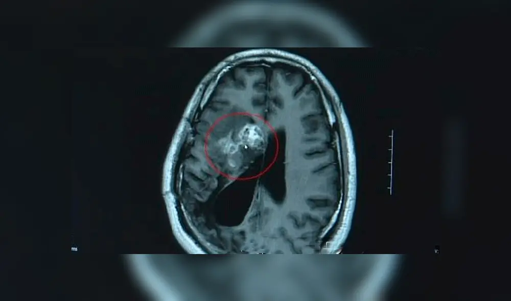 El gusano resultó ser un “Sparganum Mansoni”, que suele encontrarse en los intestinos de gatos y perros, rara vez se encuentra en humanos.