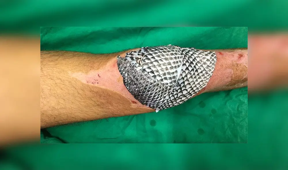 La piel del tilapia también es usado para curar quemaduras. Foto: Edmar Maciel La piel del tilapia también es usado para curar quemaduras. Foto: Edmar Maciel